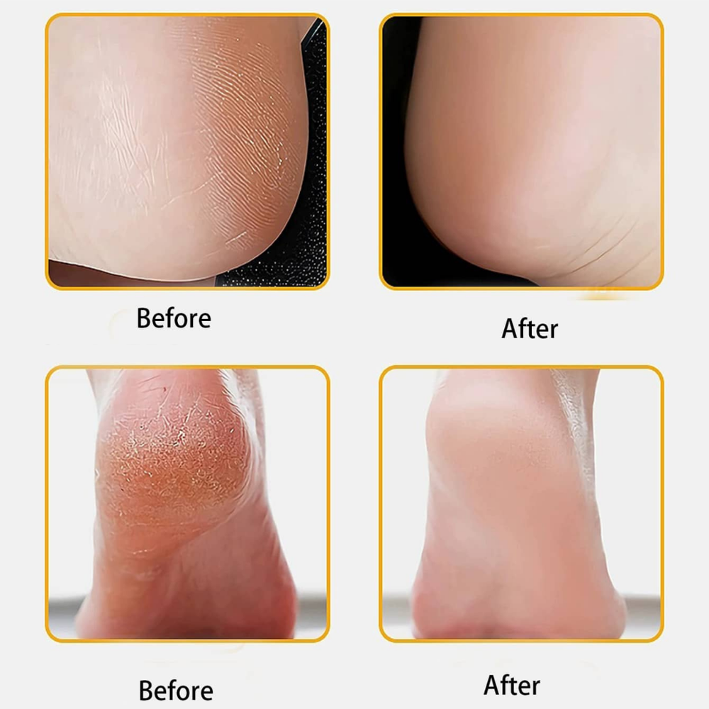 Removedor de Callos Eléctrico Recargable Exfoliante de Pies