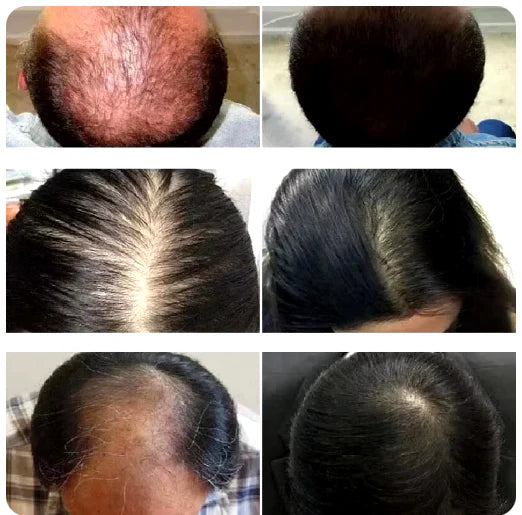 DISAAR™ SUERO CAPILAR