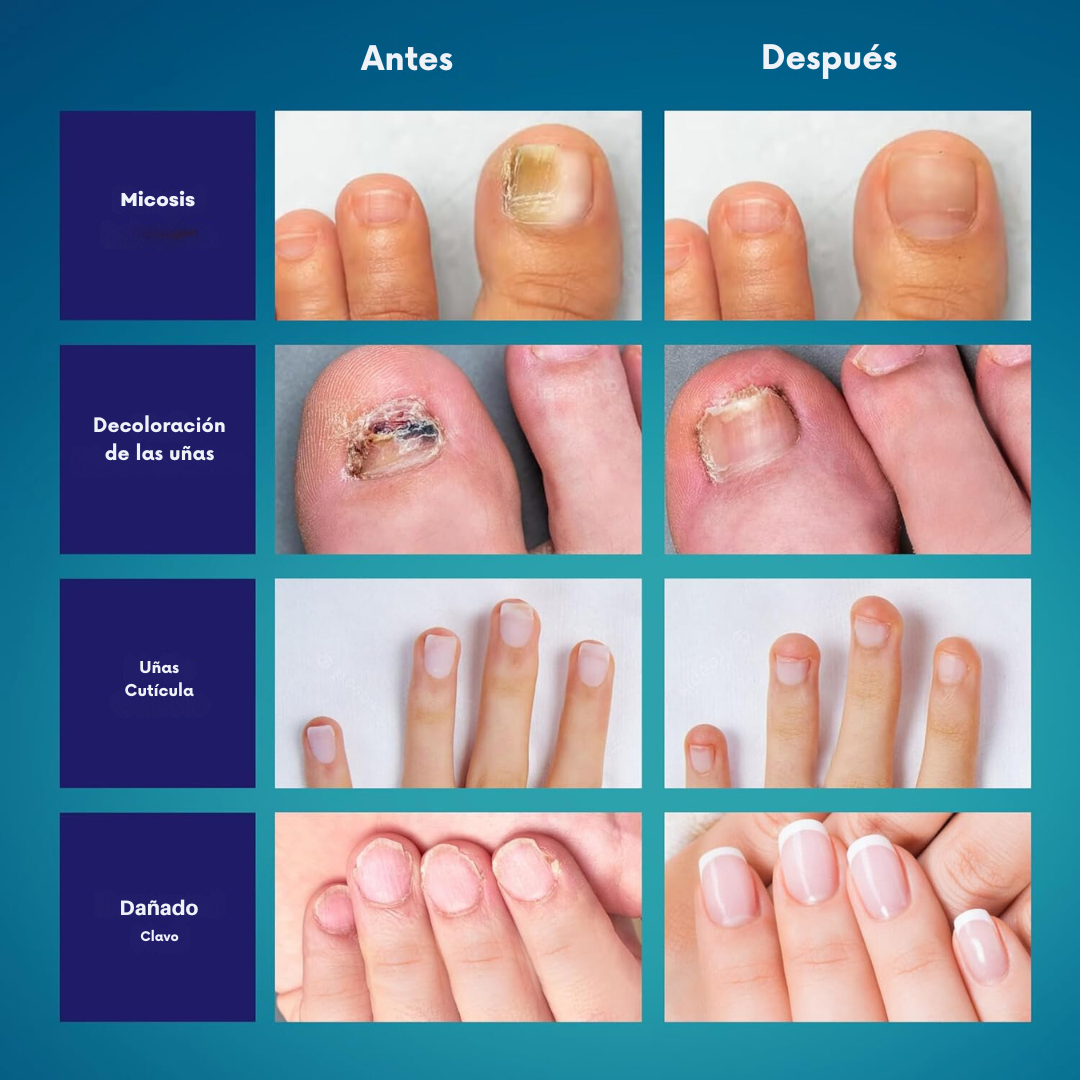 UltraClean Uñas , combate los hongos de manera eficaz